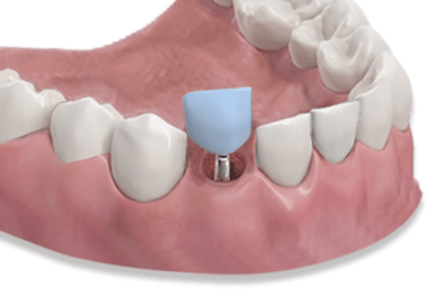 Zahnersatz auf Implantat